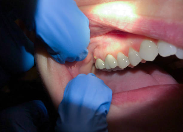 Best Emergency Dental Care for Sports Injuries in Simmesport, LA